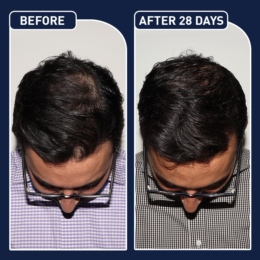 FEG Hair Growth Spray